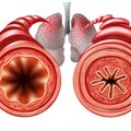 Įspėja sergančius astma: jei nors 1 iš šių 5 teiginių jums tinka, kreipkitės į gydytoją