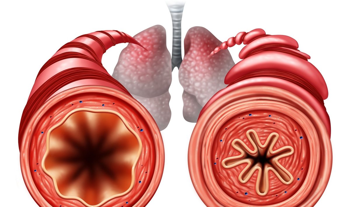 Sveikas bronchas kairėje ir sergančio astma dešinėje
