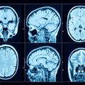 Mokslininkai pirmą kartą nustatė mirštančių žmonių smegenų suaktyvėjimą: ką tai reiškia