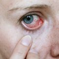 Apie COVID-19 ligą gali pranešti netikėtas požymis: atkreipkite dėmesį į akis