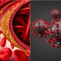 Tyrimas parodė, kaip koronavirusas susijęs su cholesteroliu