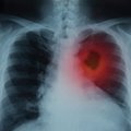 Kovai su koronavirusu pasitelkė dirbtinį intelektą: padeda analizuoti plaučių nuotraukas