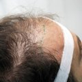 Turkai vilioja turistus pigesnėmis plaukų persodinimo operacijomis