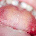 Žaizdelės burnoje atsiranda ne be priežasties: kaip jas greitai išnaikinti