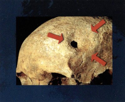 Marvelė, kapas 24 (150–300 AD). 45–50 m. moteris. 3,5 × 2 cm anga nuožulniais kraštais. Žaizda visai sugijusi. Trepanacinė anga atlikta skobimo technika.31