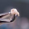 Netekus danties odontologas įspėjo nedaryti didelės klaidos: dėl to implantas kainuos tik brangiau