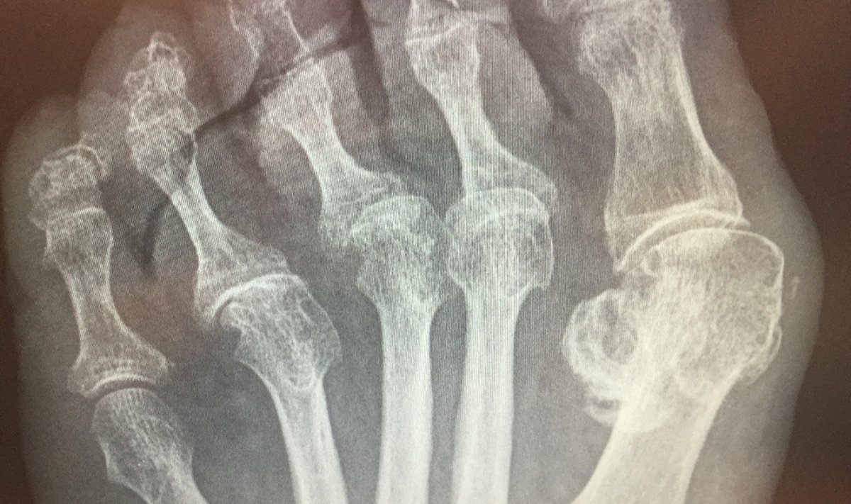 Pėdos rentgenograma