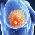 Svarbi žinia sergančios krūties vėžiu: tai gali pagerinti gyvenimo kokybę
