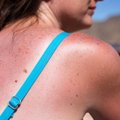 Rekordinis vasaros savaitgalis: vaistinėse – šimtai nusvilusių saulėje