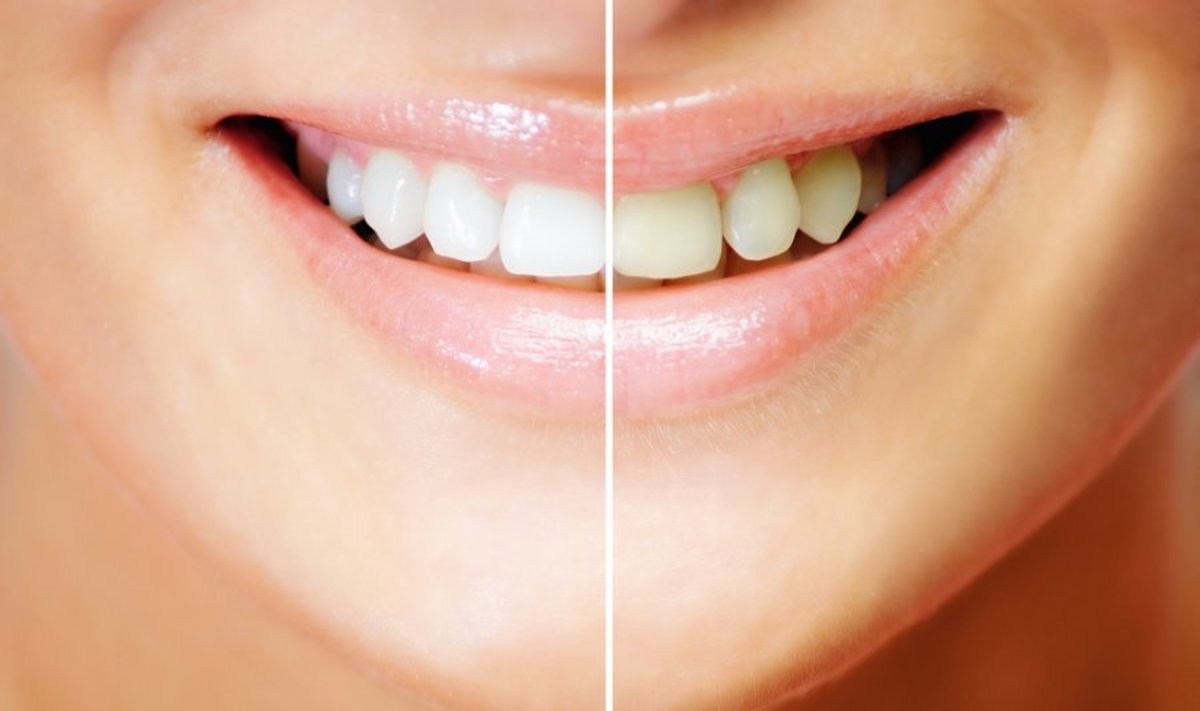 Savo dantų baltumą patikėsite natūralioms ar cheminėms priemonėms?