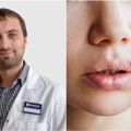 Lūpų pūslelinė gali būti rimtas organizmo įspėjimas: gydytojas pasakė, kas jį skatina labiausiai