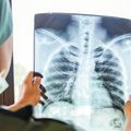 Mokslininkai žada proveržį: pirmuoju dirbtinio intelekto sukurtu vaistu tikisi gydyti sparčiai plintančią plaučių ligą