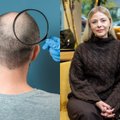 Sveikatos receptas. Plaukų retėjimas, plikimas ir kaip komiškai gali baigtis transplantacijos Turkijoje
