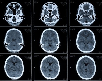 COVID-19 pažeidžia smegenis. Shutterstock/Scanpix nuotr.