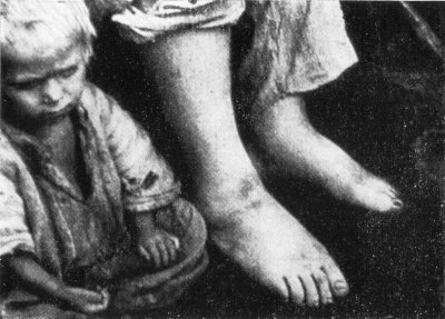 Badaujantis vaikas sėdi greta tėvo, kurio kojos sutinusios iš bado