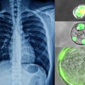 Žmogaus plaučiuose mokslininkai aptiko naujos rūšies ląsteles: žada revoliuciją gydant mirtinas ligas