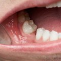Ar tikrai dėl streso galime prarasti dantis – didžiausią pavojų kelia dvi ligos