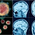 Mokslininkai gavo įrodymų, kaip COVID-19 paveikia smegenis: susirgus – ląstelių mirtis ir net encefalopatija