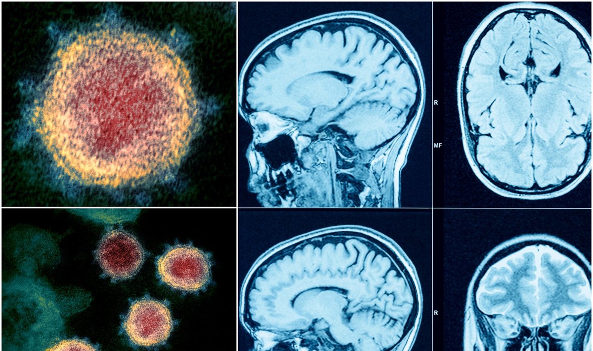 Koronaviruso infekcija pažeidžia ir smegenis. Shutterstock/NIAID nuotr.