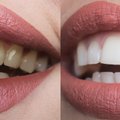 6 priežastys, kodėl pagelsta dantys