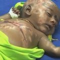 Indijoje kūdikiui ant kūno savaime atsiranda nudegimų