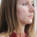 Randus paliekanti odos liga – kodėl svarbu pradėti gydytis laiku?