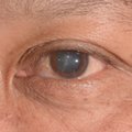 Klastinga akių liga Eleną užklupo vos sulaukus 40 metų: padėti galėjo tik operacija