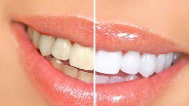 Burnos higienistė išvardijo netikėtas priežastis, kodėl pagelsta dantys: aptarė galimus balinimo būdus