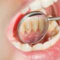 Kaip apmažinti dantų apnašų susidarymą natūraliais būdais: kai kurių produktų reikėtų vengti