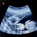 Stebuklui prilygstantis atvejis: dvi gimdas turinti moteris pagimdė dvynukus