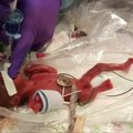 Mažiausias pasaulyje išgyvenęs kūdikis paliko ligoninę