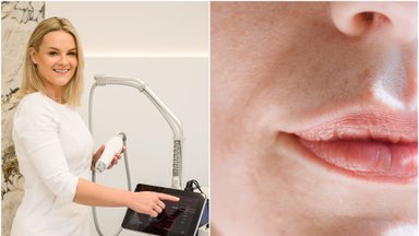 Gydytoja – apie lūpų korekcijas: kokios gresia komplikacijos ir, kaip jų išvengti