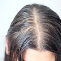 Pagrindinės plaukų retėjimo priežastys ir kaip jį sustabdyti: įvardijo net liaudiškas priemones
