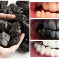 Naujas dantų balinimo būdas: efektas džiugina, bet rizika didesnė