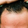 Dažnam po COVID-19 pradeda kuokštais slinkti plaukai: gydytoja ramina – tai išsprendžiama bėda