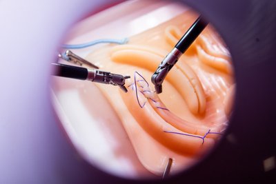 Robotinė operacija Santaros klinikose
