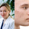 Gydytoja dermatologė pasakoja apie odos ligą, kuri žymi daugelio mūsų paauglystę – šiandien požiūris į ją visai kitoks