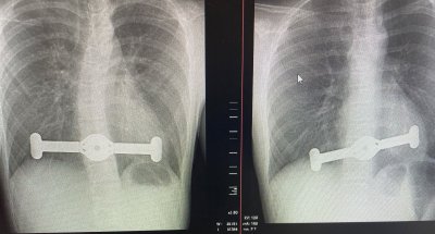 Krūtinės ląstos prieš ir po operacijos rentgeno nuotraukos