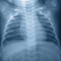Ar tikrai nepavojingi vaikams rentgeno tyrimai?