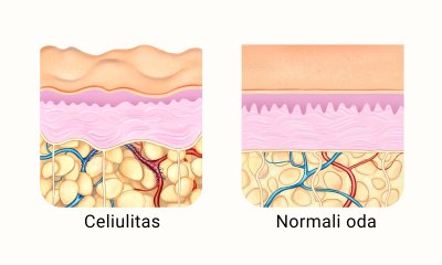 Celiulitas