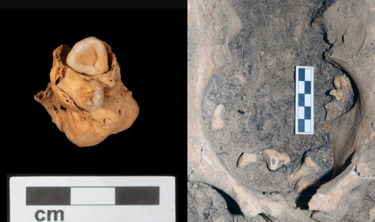 Senovės Egipto laikų moters palaikai, kuriuose aptikti dubenyje išaugę dantys. M. Wetzel / A. Deblauwe / Amarna Project archyvo nuotr.