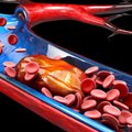 Gydytojas atsakė, ar galima sumažinti cholesterolio kiekį be vaistų