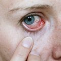 Varginanti akių liga gali užklupti kiekvieną