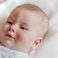 Kūdikių odos bėrimai, kuriuos privalo atpažinti visi tėvai: gydytoja paaiškino, kurie iš jų kelia pavojų sveikatai