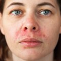 Žmonės dažnai be reikalo nesureikšmina pirmųjų odos ligų simptomų: gydytoja siūlo nedelsti