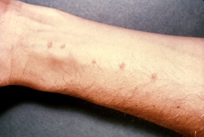 Šistosomatozę sukeliantys parazitai prasiskverbia per odą. Cornellier/CDC Wikipedia nuotr.