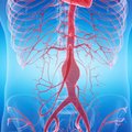 Išvardijo pilvo aortos aneurizmos simptomus: vienas iš jų gali būti ir nugaros skausmas