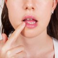 Lūpų pūslelinė: gydytoja pasakė, kas ją pažadina ir kaip kuo greičiau atsikratyti nemalonių simptomų