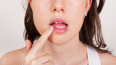 Lūpų pūslelinė: gydytoja pasakė, kas ją pažadina ir kaip kuo greičiau atsikratyti nemalonių simptomų