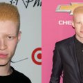 Vaikystėje patyčias patyręs albinosas tapo supermodeliu